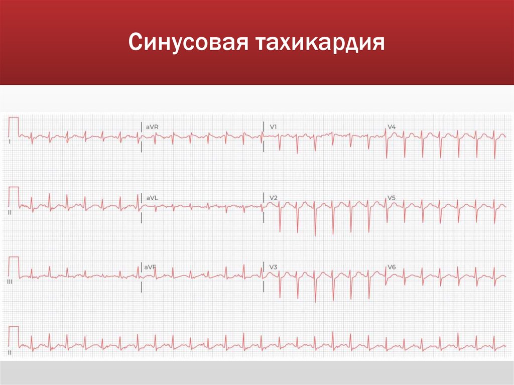 Синусовая тахикардия
