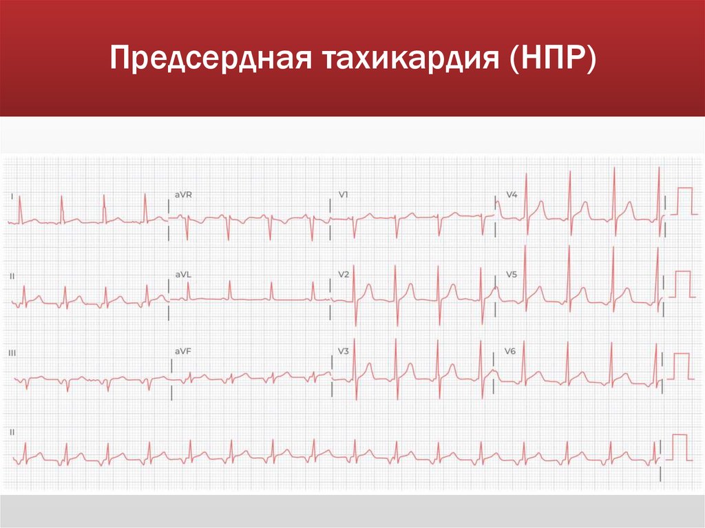Предсердная тахикардия (НПР)
