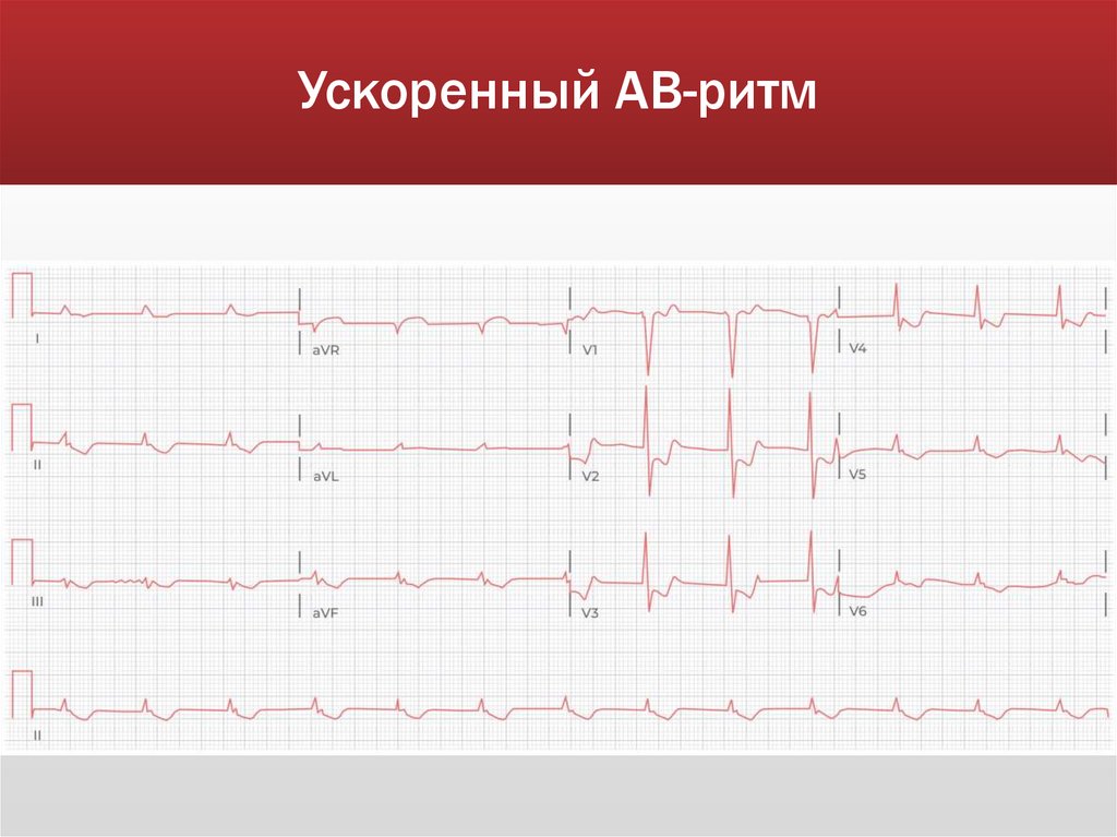 Ускоренный АВ-ритм