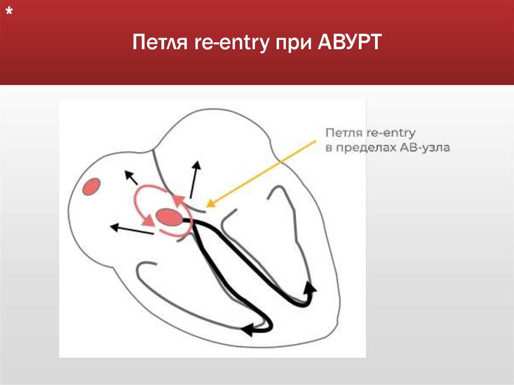 Петля re-entry при АВУРТ