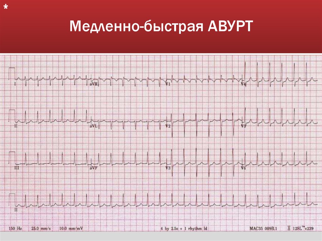 Медленно-быстрая АВУРТ