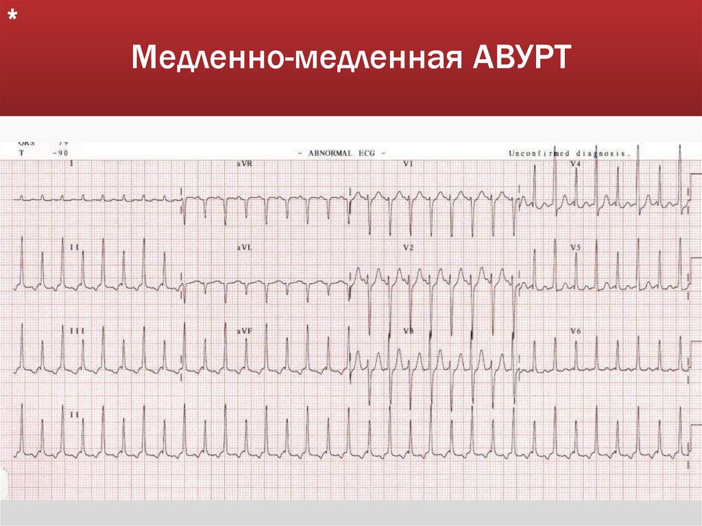 Медленно-медленная АВУРТ