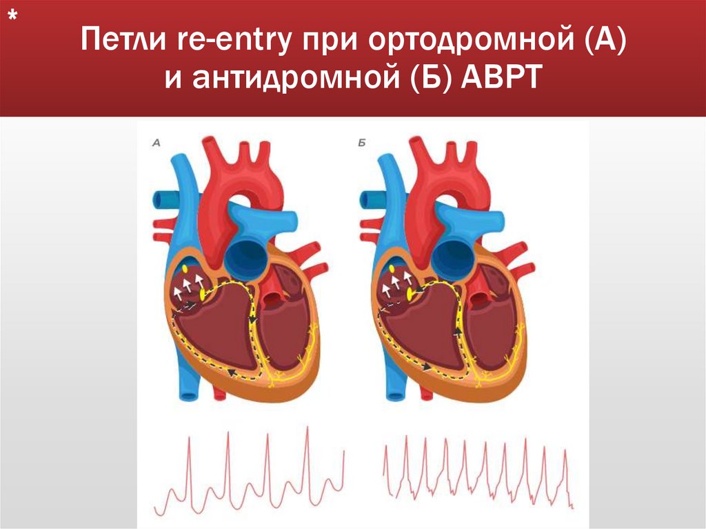 Петли re-entry при ортодромной (А) и антидромной (Б) АВРТ