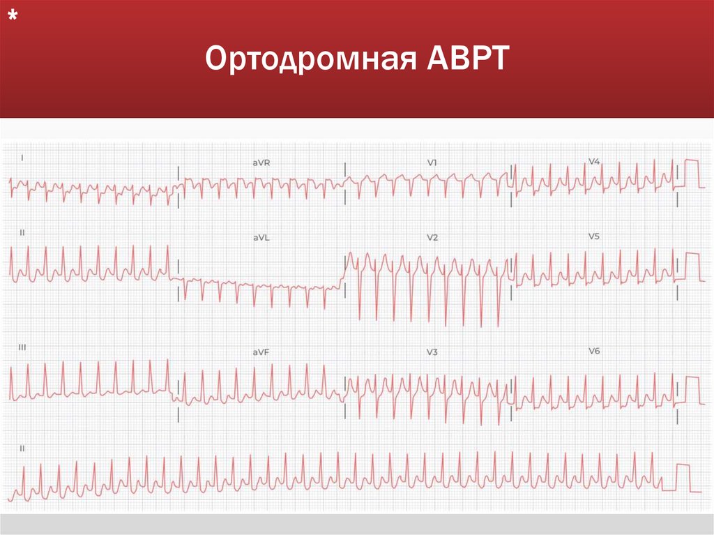 Ортодромная АВРТ
