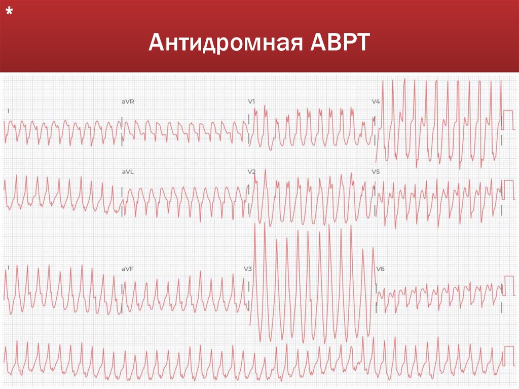 Антидромная АВРТ