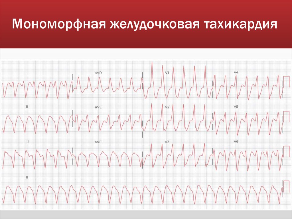 Мономорфная желудочковая тахикардия