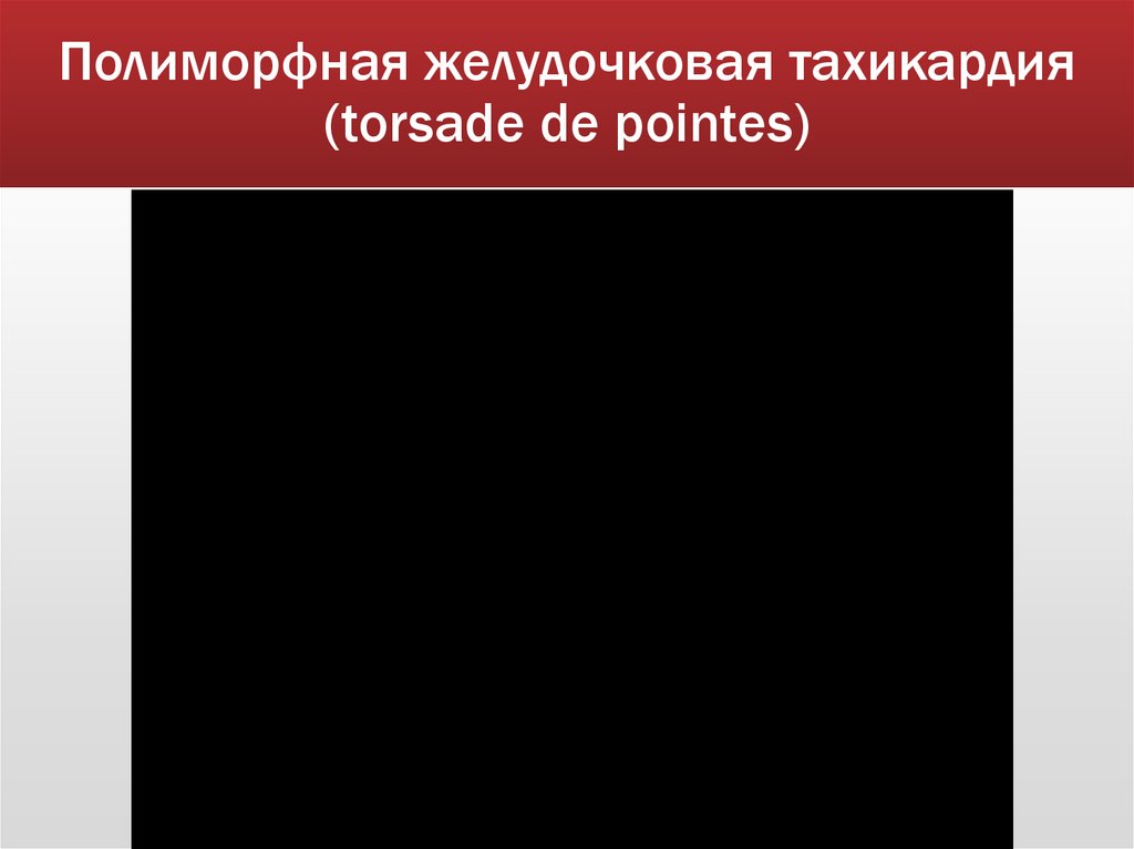 Полиморфная желудочковая тахикардия (torsade de pointes)