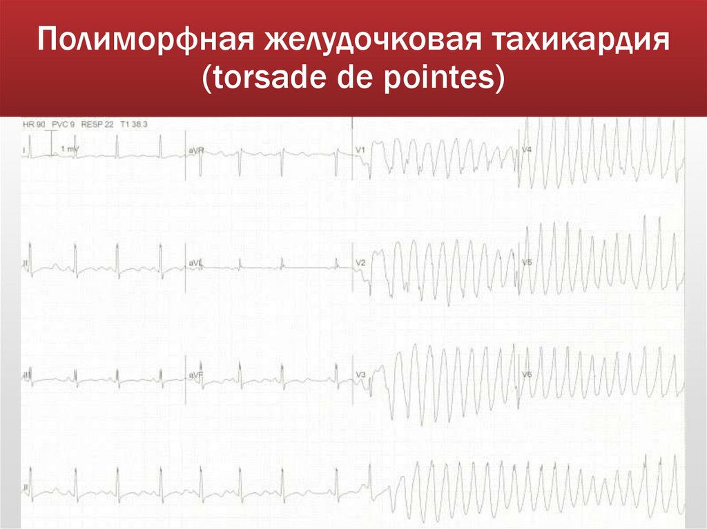 Полиморфная желудочковая тахикардия (torsade de pointes)
