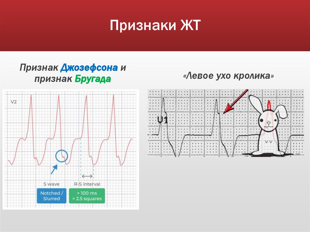 Признаки ЖТ