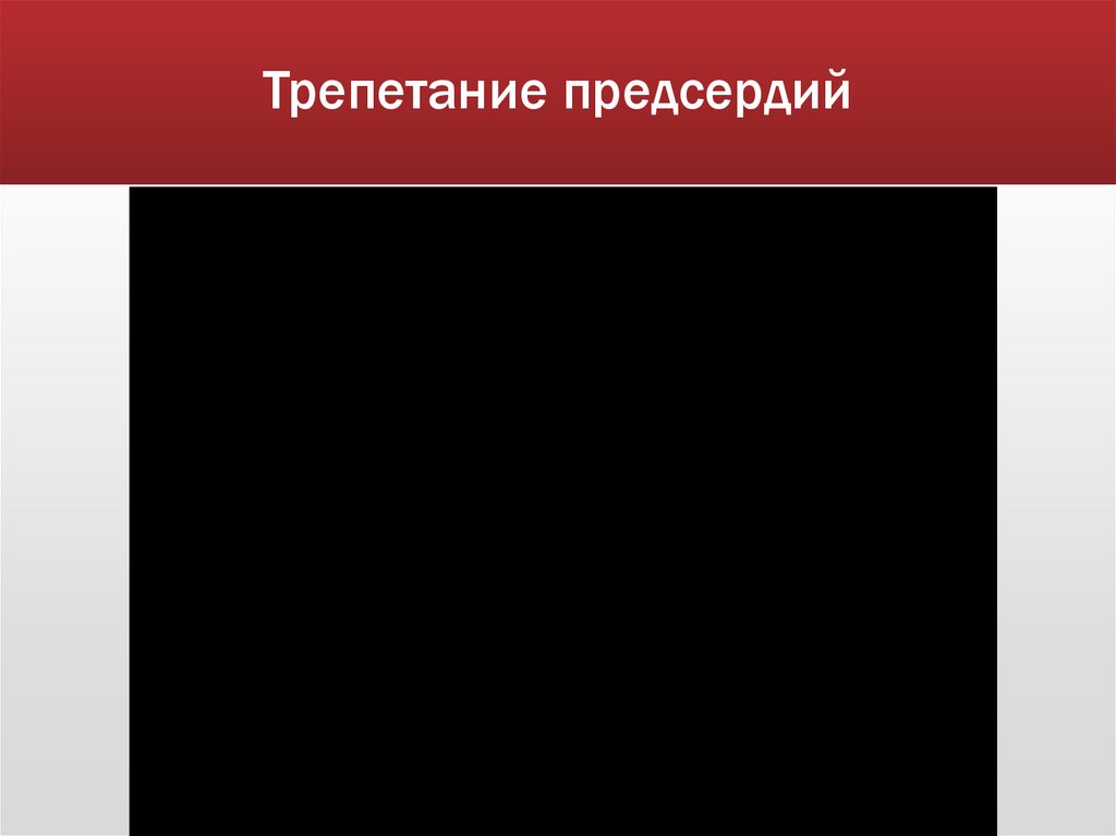 Трепетание предсердий