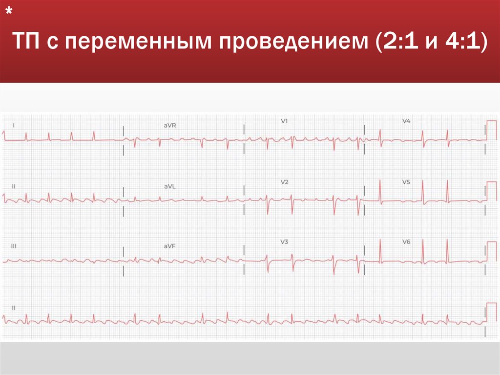ТП с переменным проведением (2:1 и 4:1)