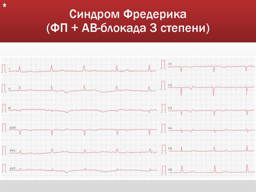 Синдром Фредерика (ФП + АВ-блокада 3 степени)