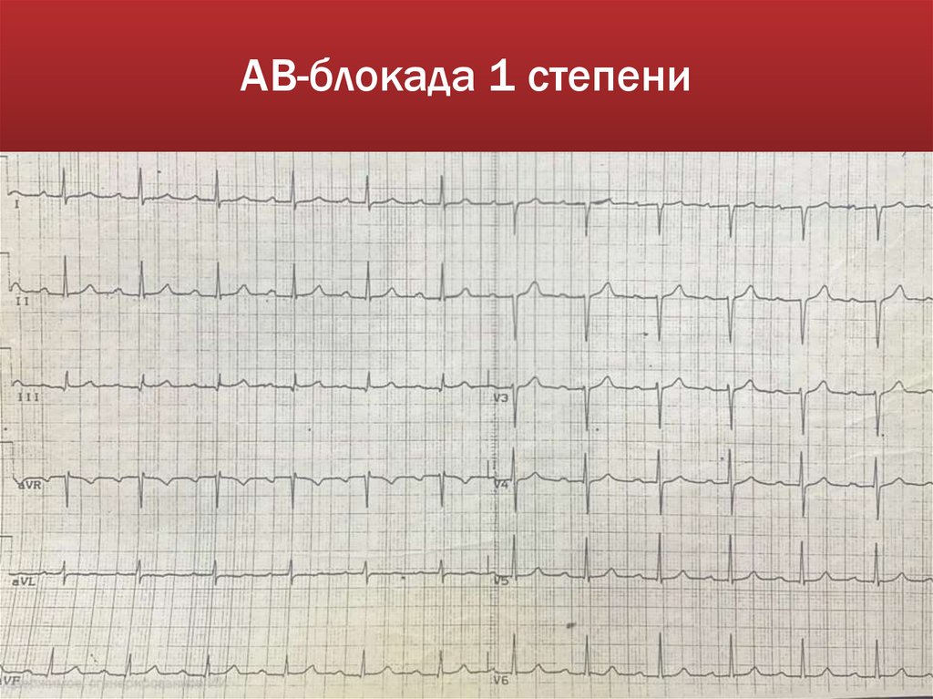 АВ-блокада 1 степени