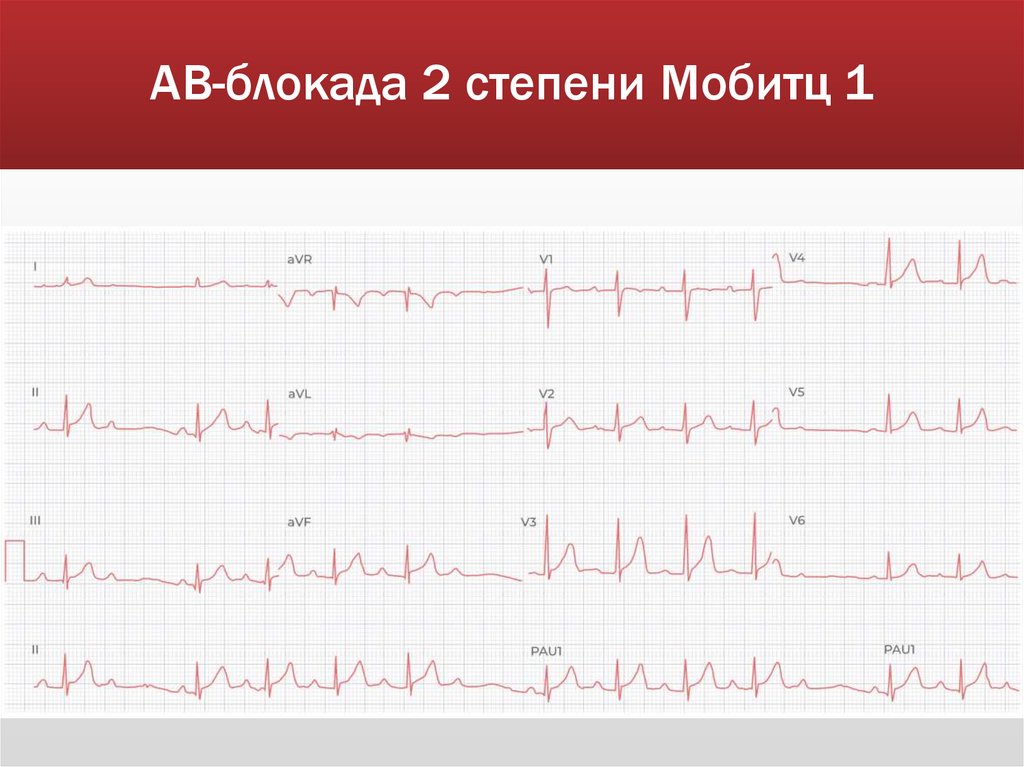 АВ-блокада 2 степени Мобитц 1