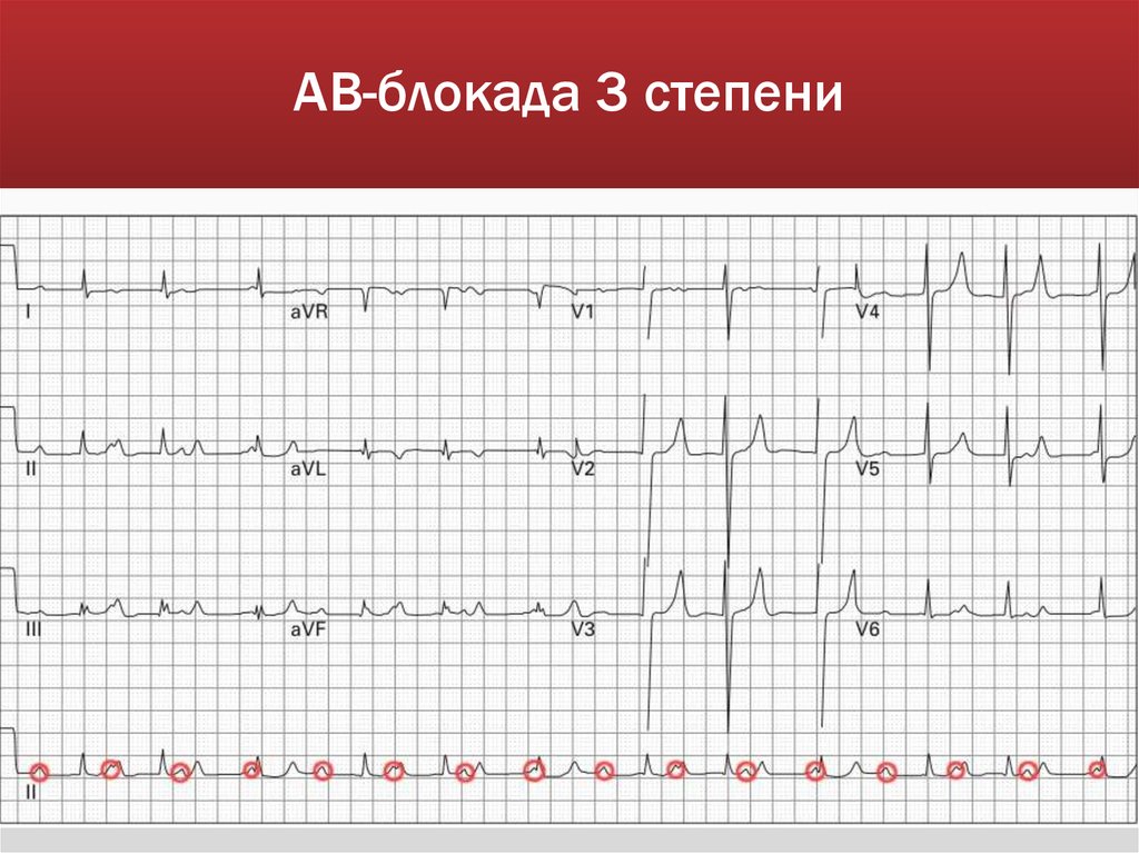 АВ-блокада 3 степени