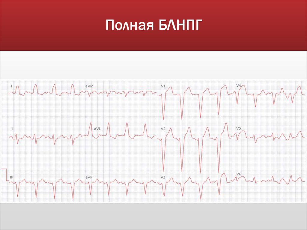 Полная БЛНПГ