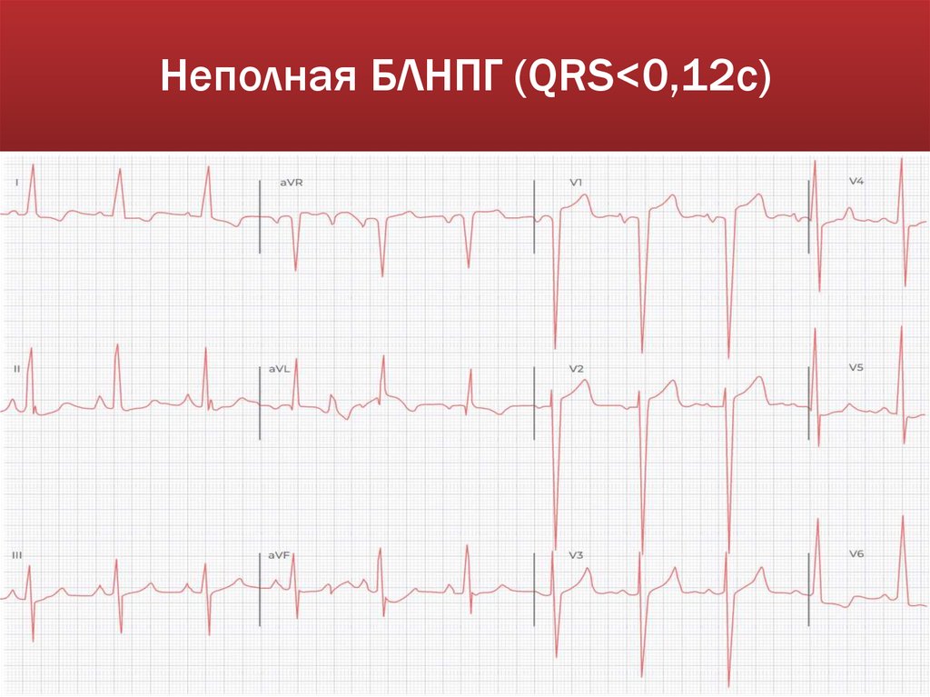 Неполная БЛНПГ (QRS<0,12c)