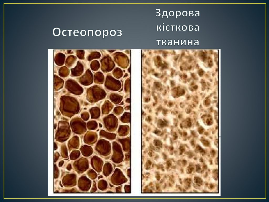 Остеопороз