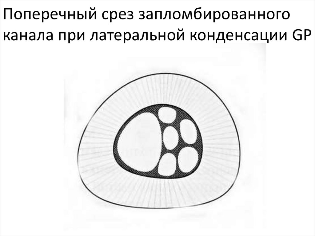 Поперечный срез запломбированного канала при латеральной конденсации GP
