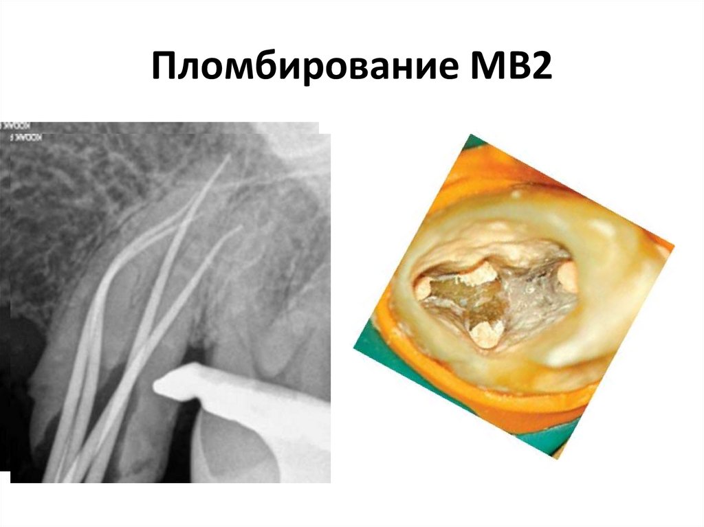 Пломбирование МВ2