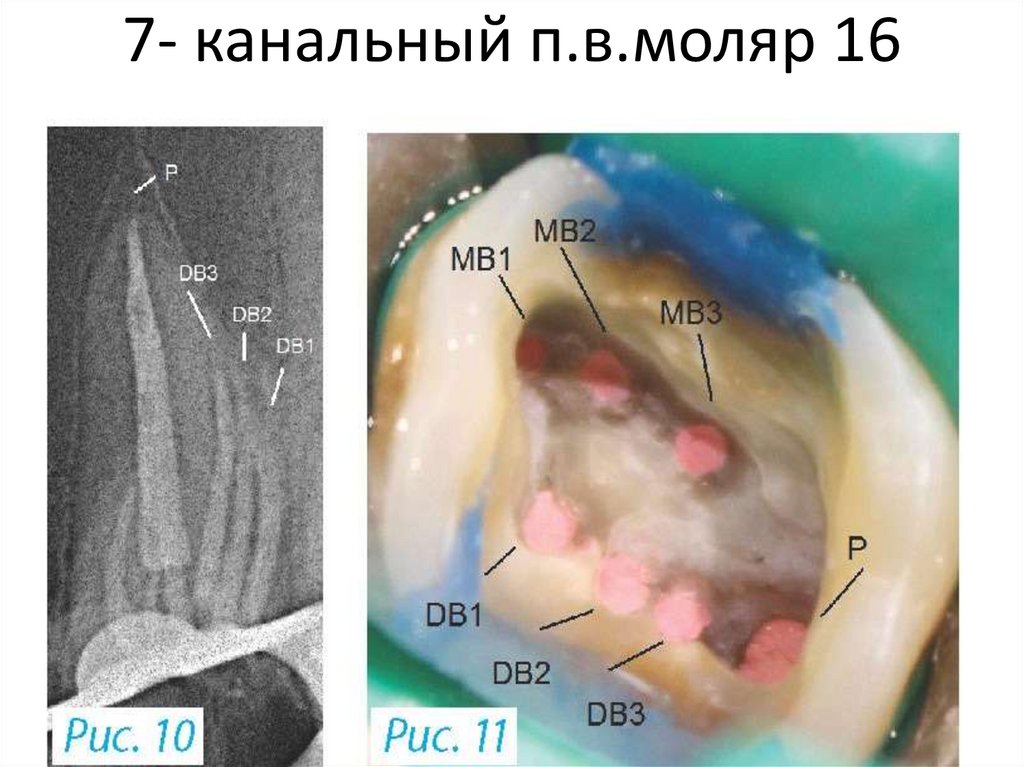 7- канальный п.в.моляр 16