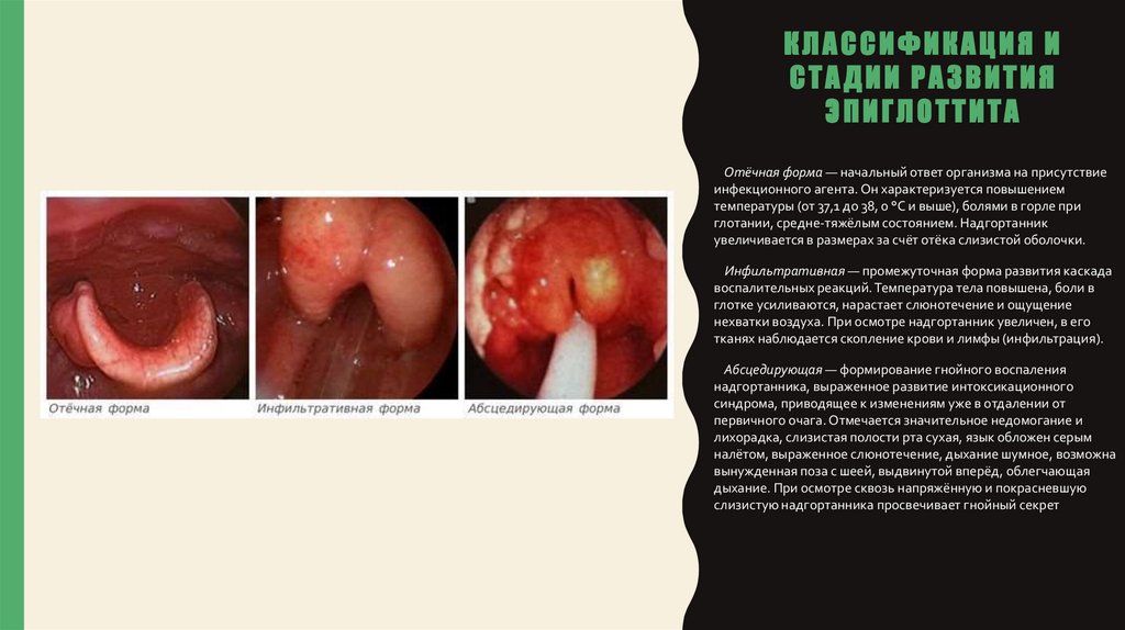 Классификация и стадии развития эпиглоттита