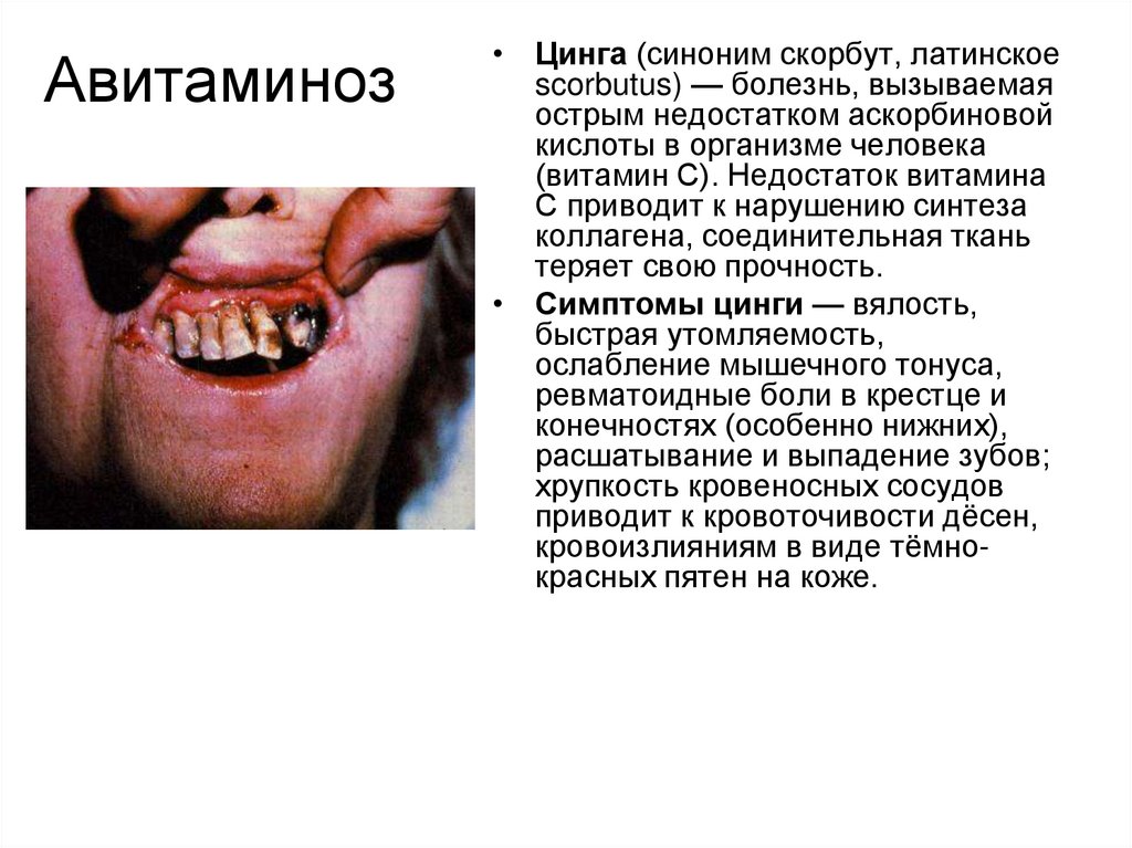 Авитаминоз