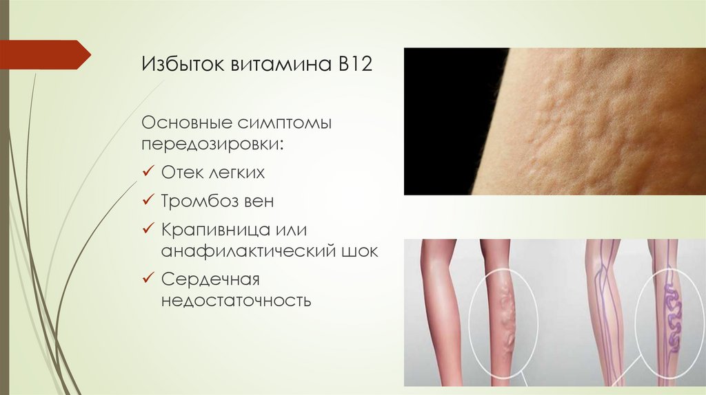 Избыток витамина В12