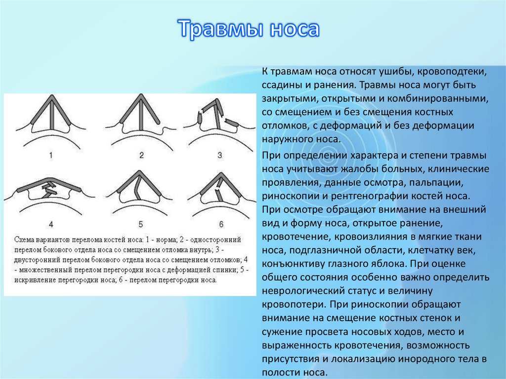 Травмы носа