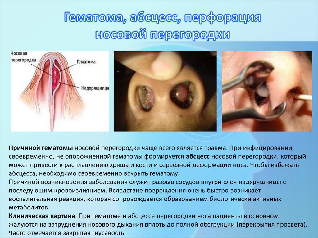 Гематома, абсцесс, перфорация носовой перегородки