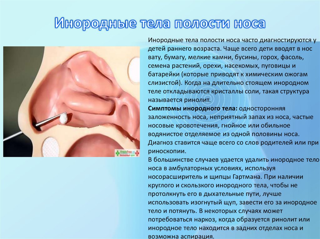 Инородные тела полости носа