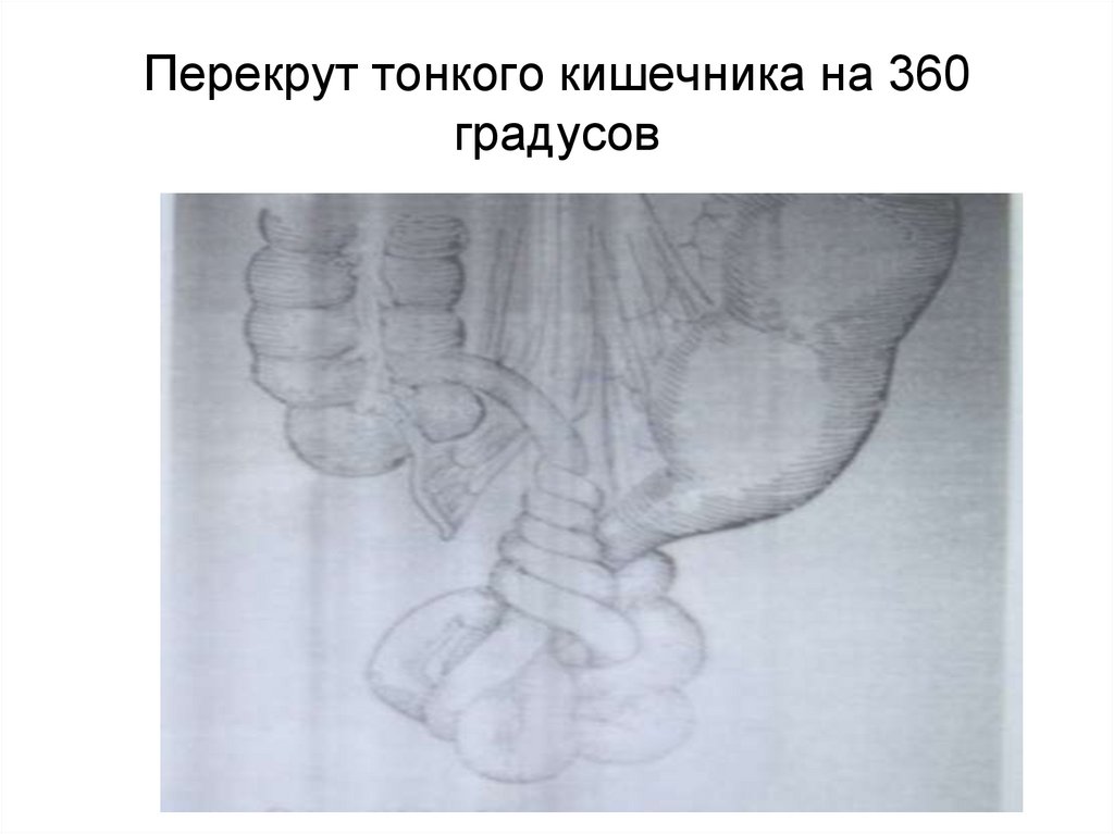 Перекрут тонкого кишечника на 360 градусов