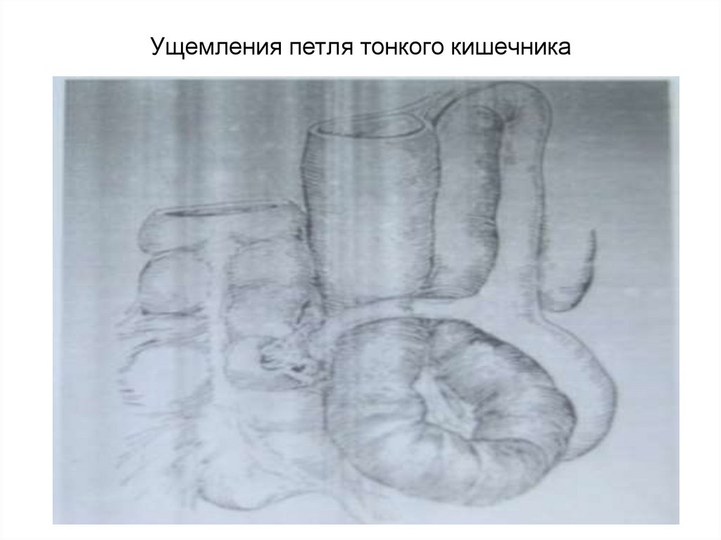 Ущемления петля тонкого кишечника