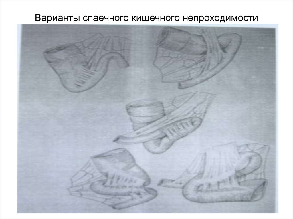 Варианты спаечного кишечного непроходимости