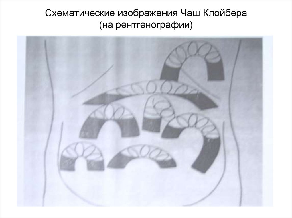 Схематические изображения Чаш Клойбера (на рентгенографии)