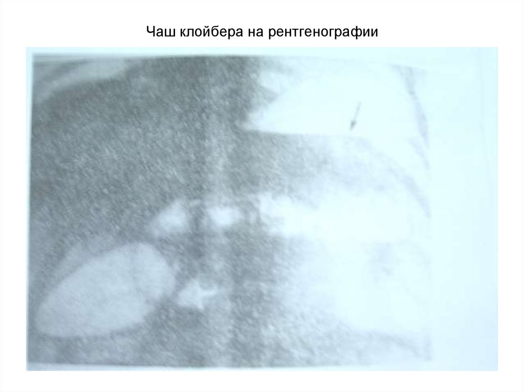 Чаш клойбера на рентгенографии