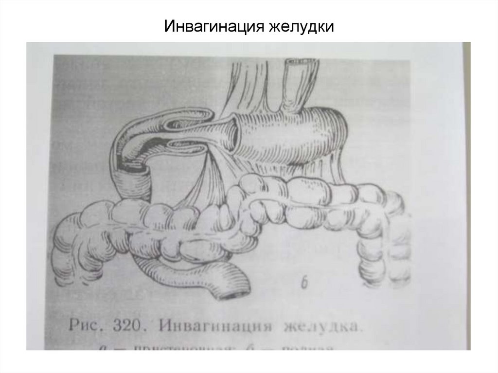 Инвагинация желудки