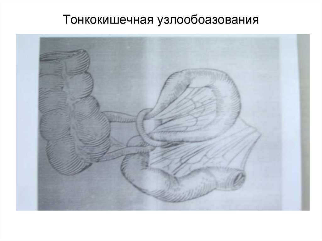 Тонкокишечная узлообоазования