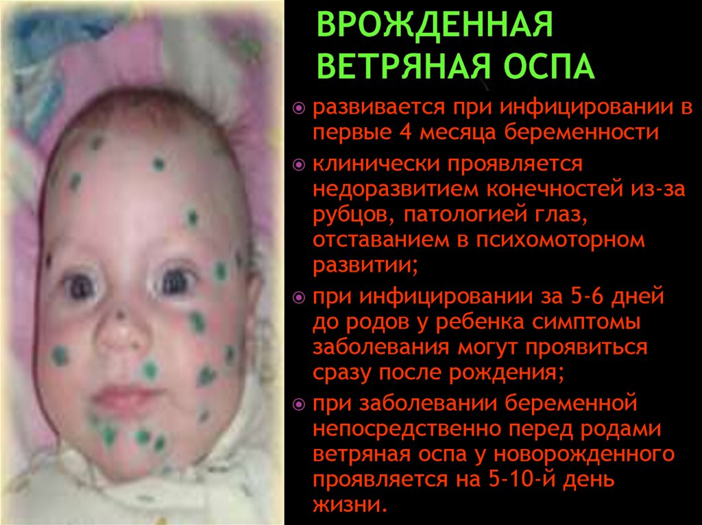 Врожденная ветряная оспа