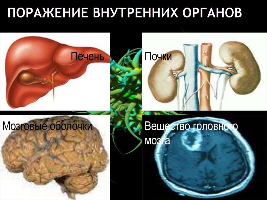 поражение внутренних органов