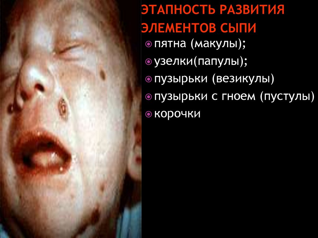 Этапность развития элементов сыпи