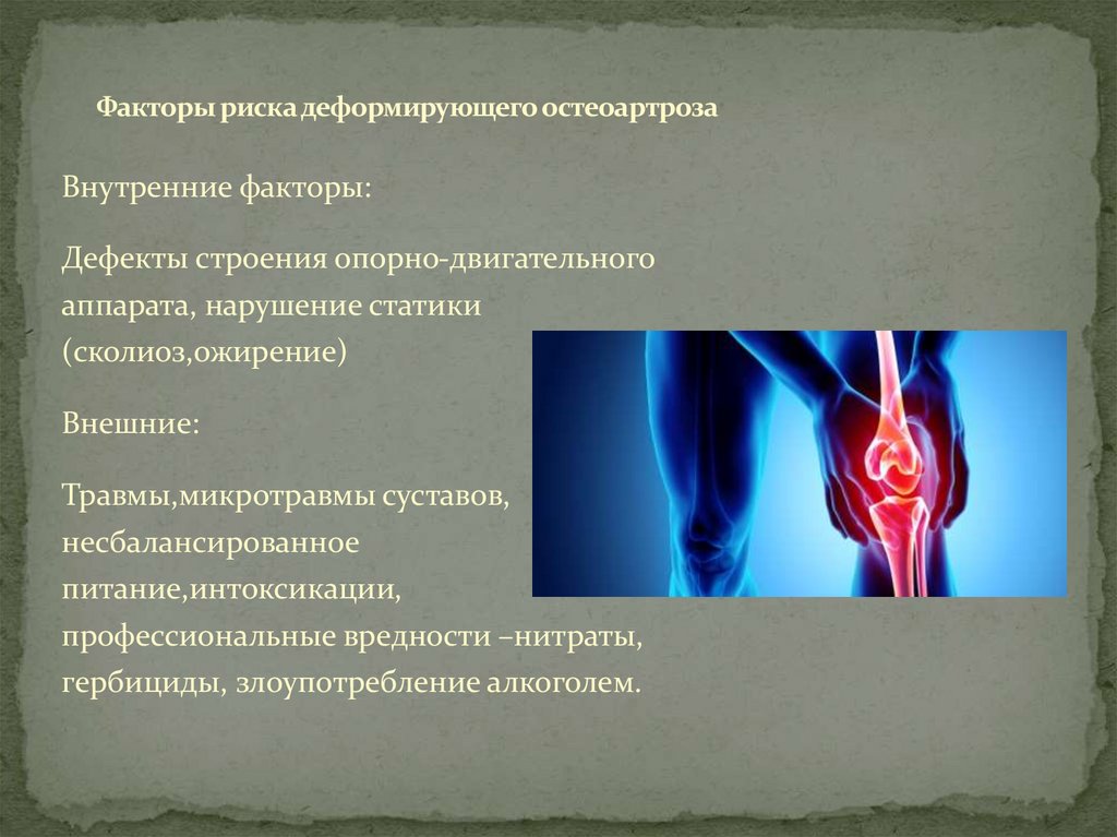 Факторы риска деформирующего остеоартроза