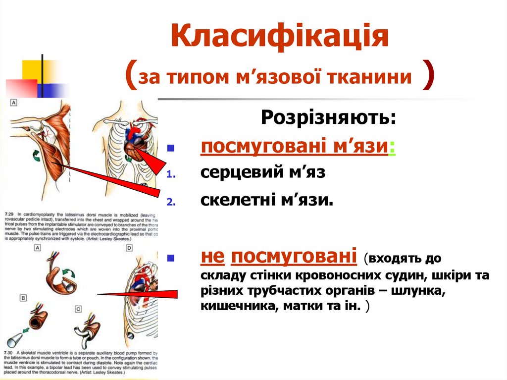 Класифікація (за типом м’язової тканини )