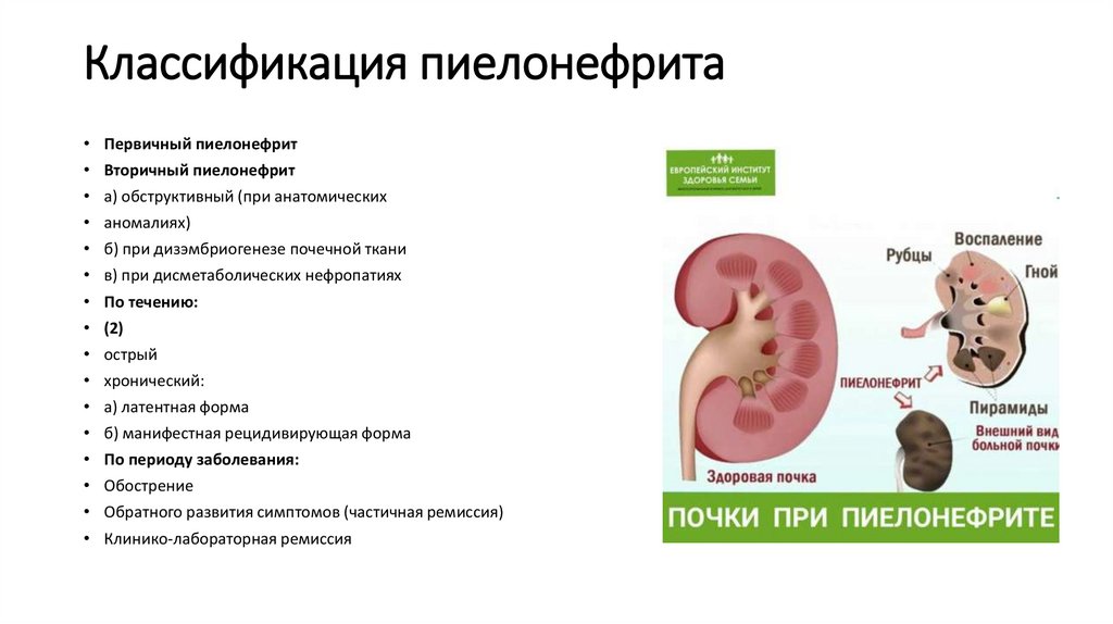 Классификация пиелонефрита