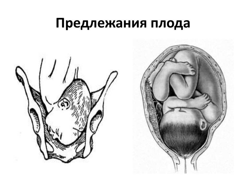 Предлежания плода