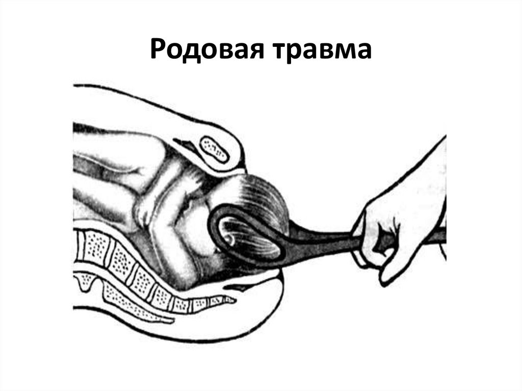 Родовая травма