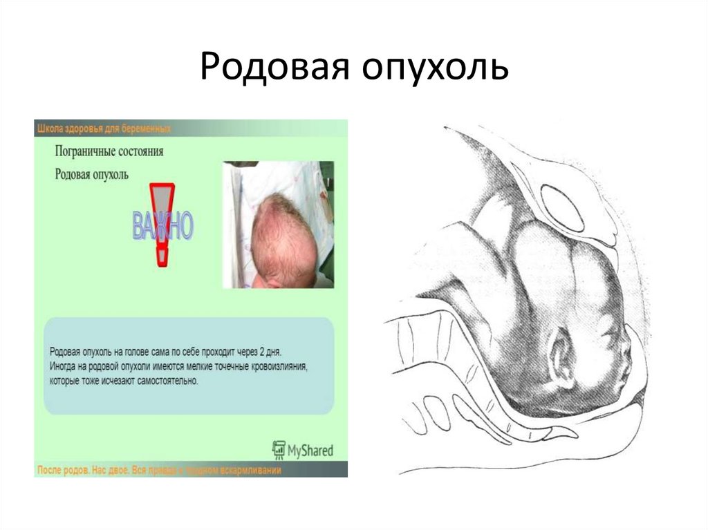 Родовая опухоль