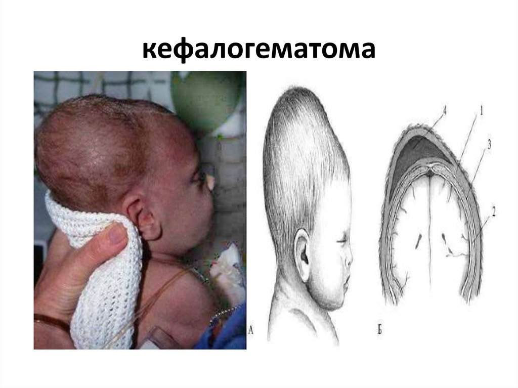 кефалогематома