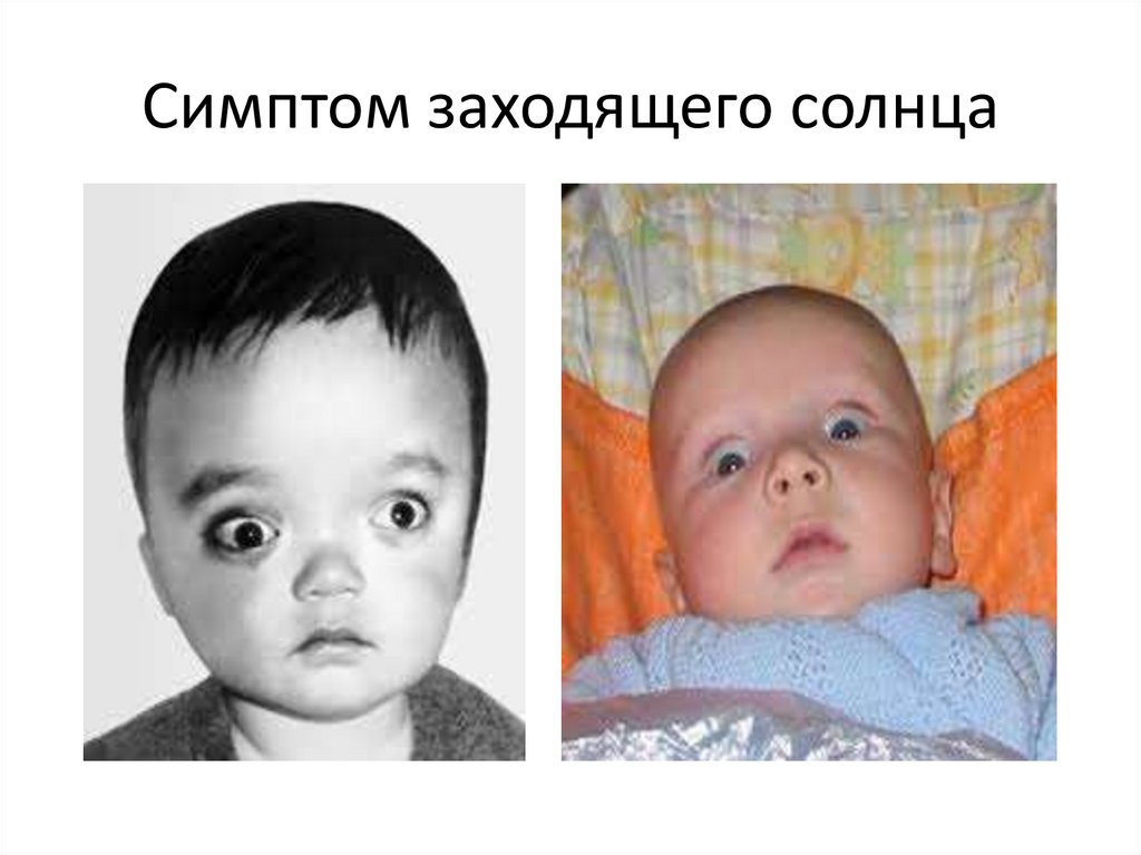 Симптом заходящего солнца