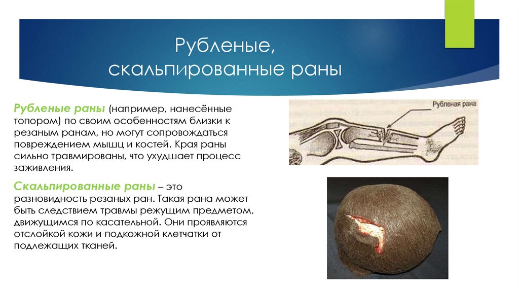 Рубленые, скальпированные раны